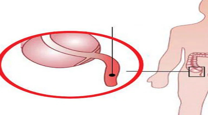 অ্যাপেন্ডিসাইটিস কি? যেভাবে বুঝবেন আপনার অ্যাপেন্ডিসাইটিস হয়েছে